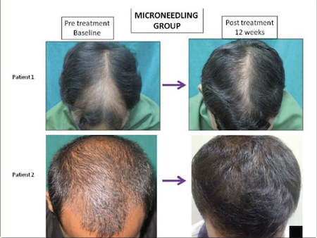 From the Randomized Evaluator Blinded Study of Effect of Microneedling in Androgenetic Alopecia:
