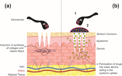 Derma rolling produces collagen and also allows minoxidil to work better