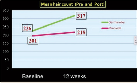 Minoxidil vs. Minoxidil+Dermaroller