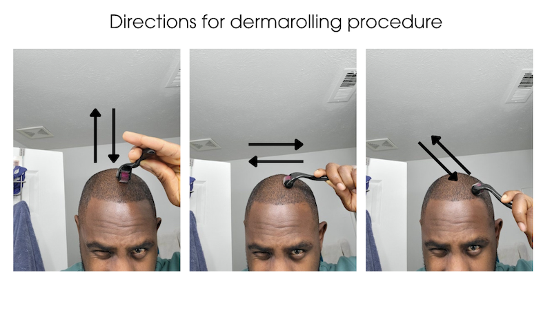 Derma rolling is really this simple. Just do this until your scalp is mildly irritated.