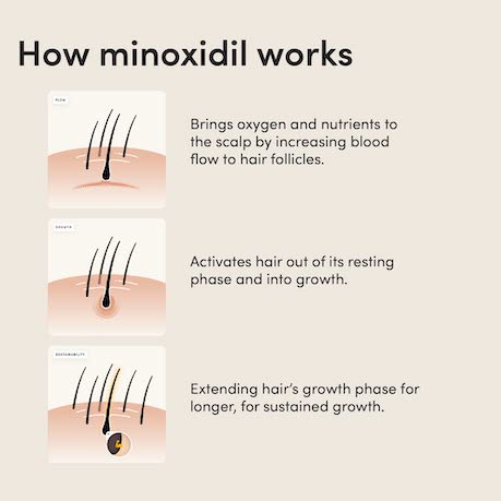 How Minoxidil stops hair loss
