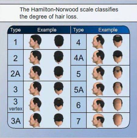 Norwood Chart Pattern Baldness