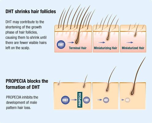 How finasteride stops hair loss