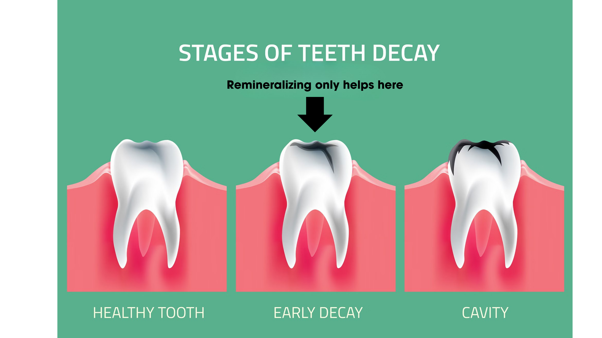 Remineralizing gum does not fix cavities