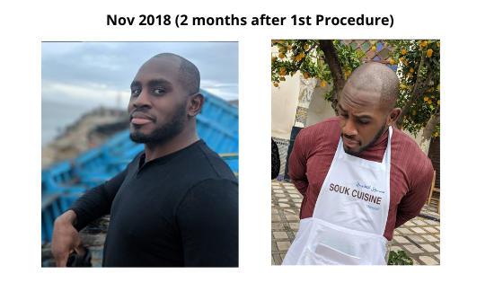 2 months after hair transplant