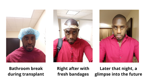 During the day of my fue hair transplant with Bosley