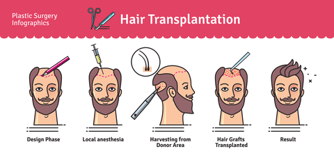 Fue hair transplant diagram