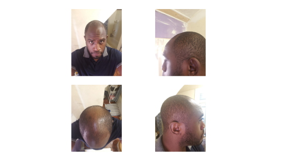 Ed Latimore hair loss prevention and maintenance protocol