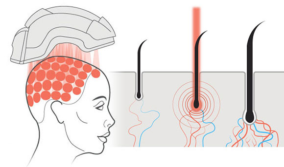 How does Low-Level Light Therapy (lllt) stop hair loss?